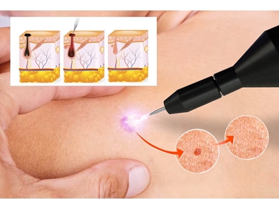 Cold Pen Arc Sistem Plazma Cihazı - 1