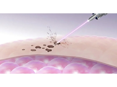 Cold Pen Arc Sistem Plazma Cihazı - 2